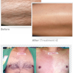 men's acne scar treatment