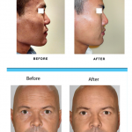 men's facial rejuvenation